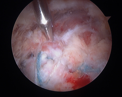 Endoscopic Abductor Tendon Repair